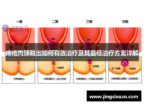 痔疮肉球脱出如何有效治疗及其最佳治疗方案详解